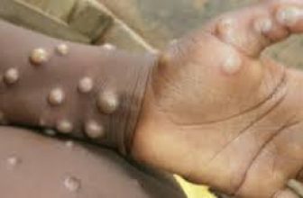 السودان.. تسجيل أكثر من 200 إصابة بـ”جدري القرود” في 3 مناطق
